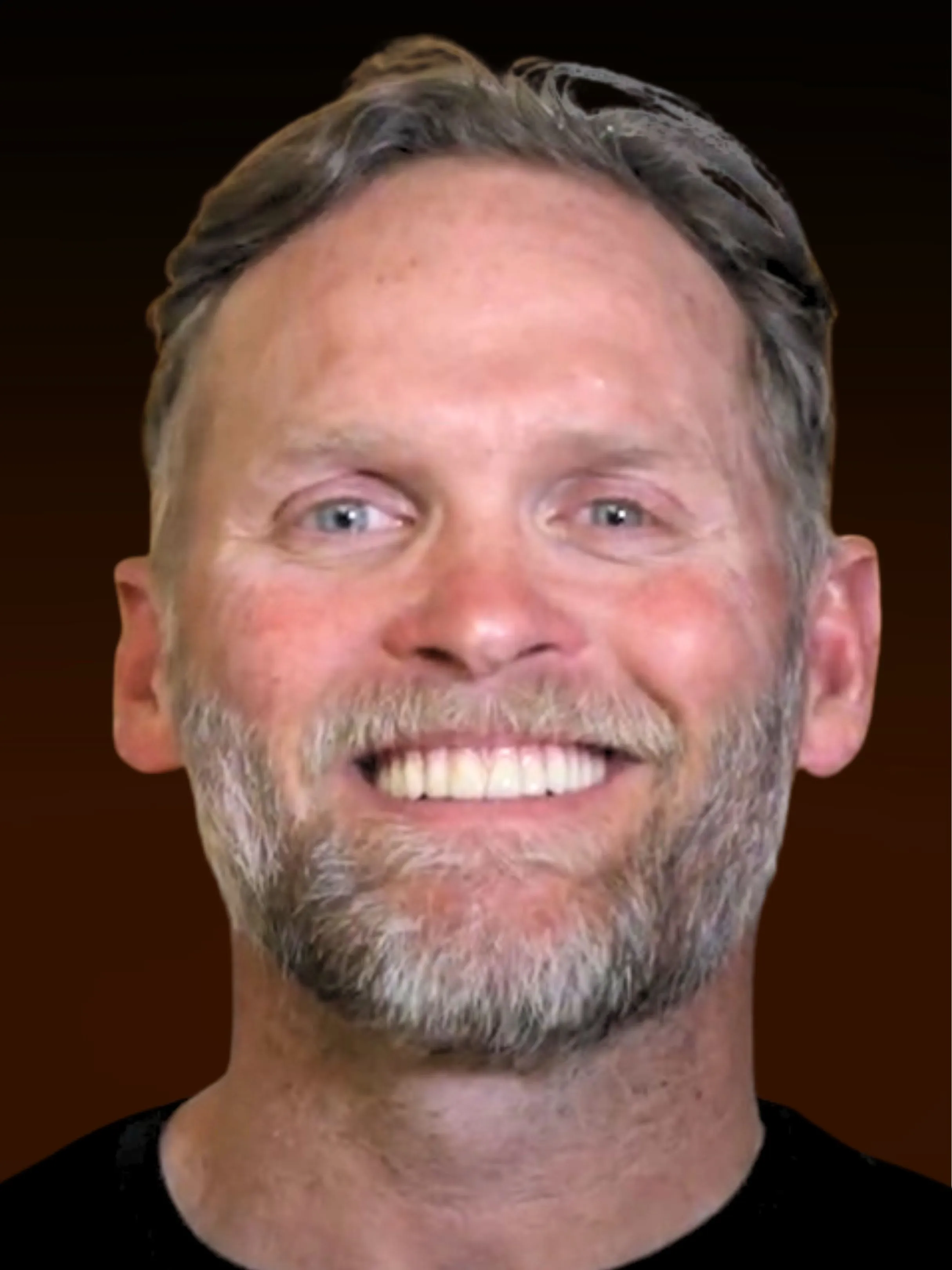 Patient Casey after full arch restoration — permanent teeth replacement in Northwest Indiana