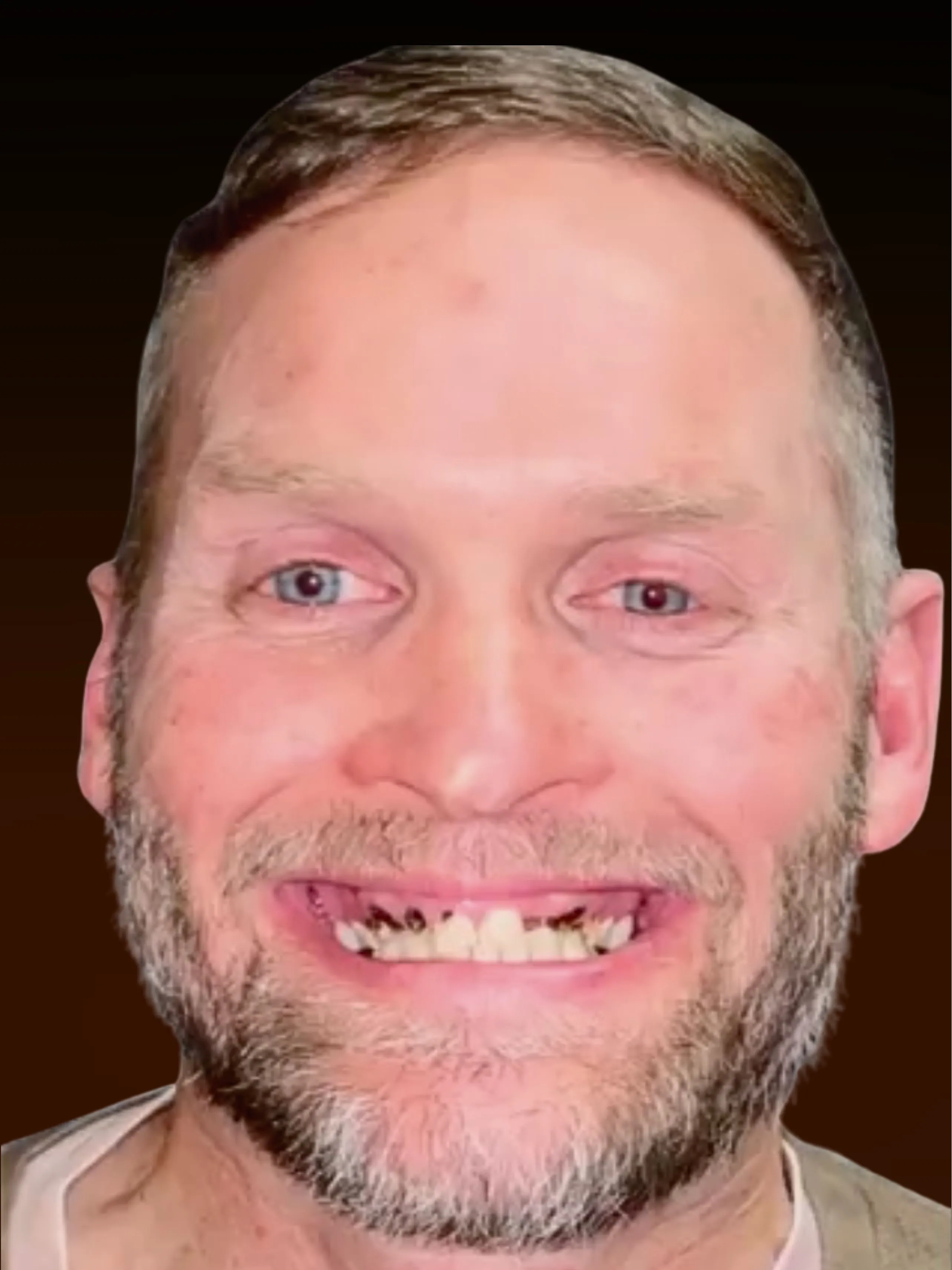 Patient Casey before implant-supported dentures at Pulver Oral Surgery, Highland IN