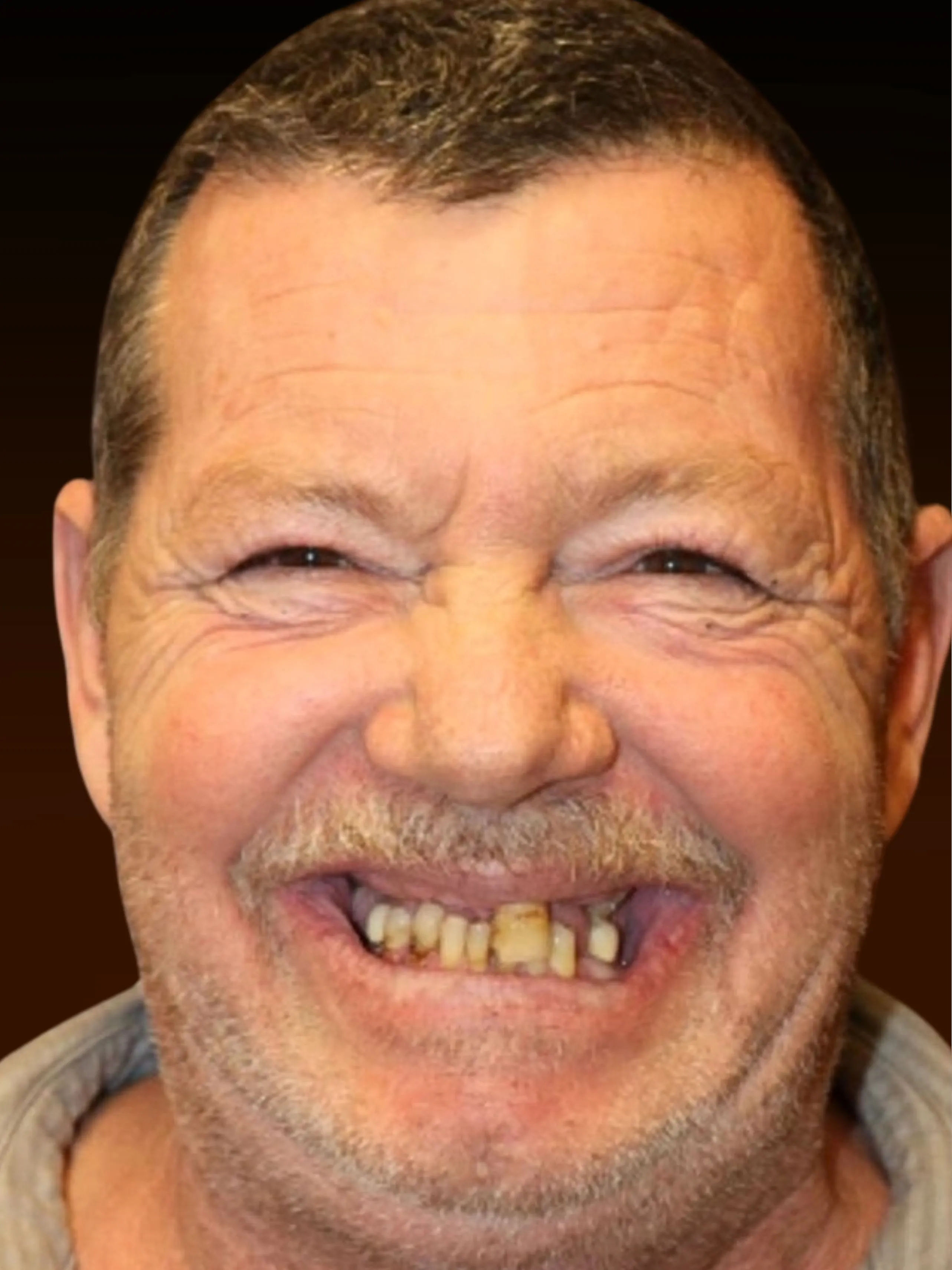 Patient John before same-day dental implants at Pulver Oral Surgery, Highland IN