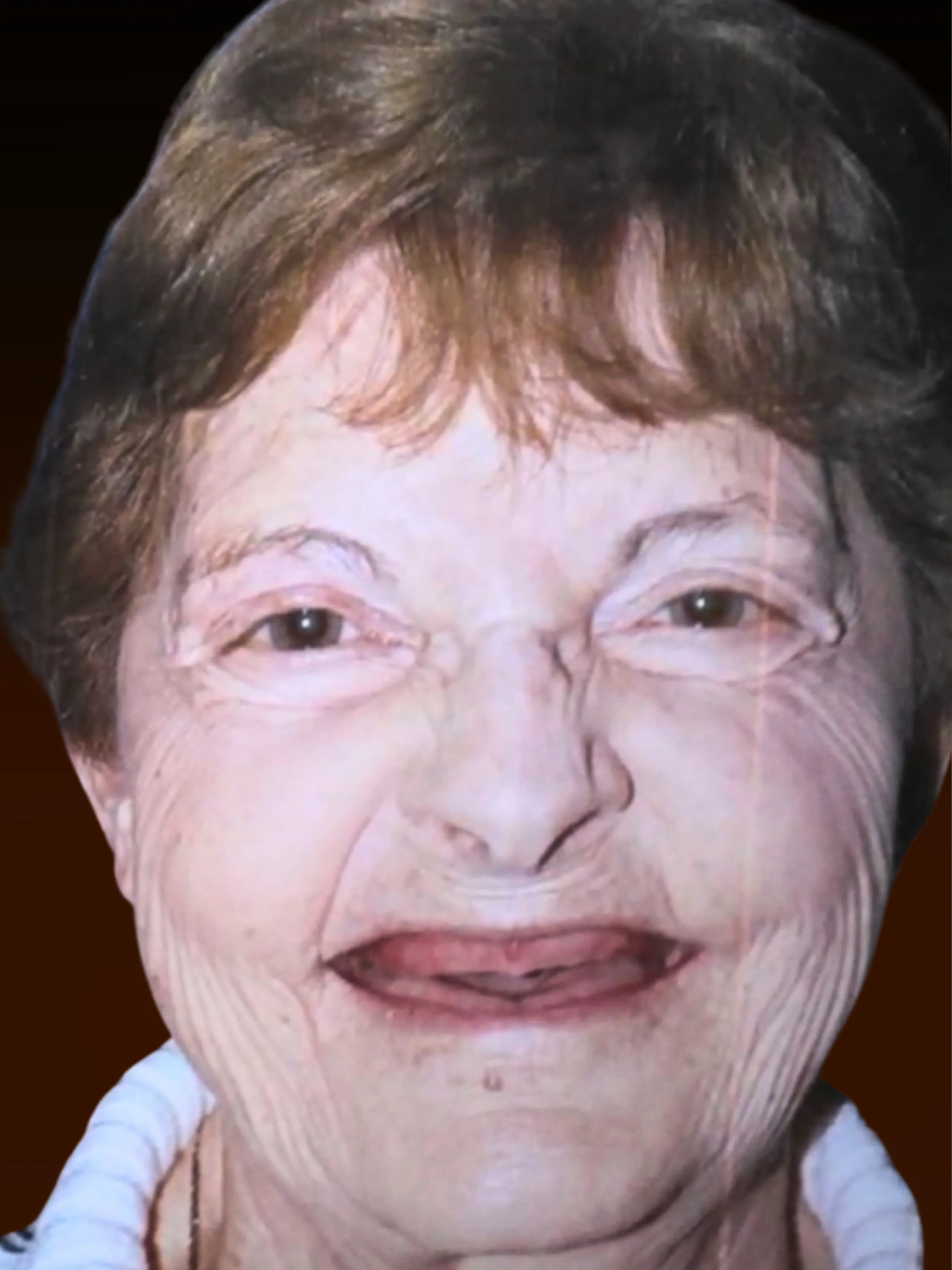 Patient Lois before All-on-4 dental implants at Implanted Wisdom, Highland Indiana