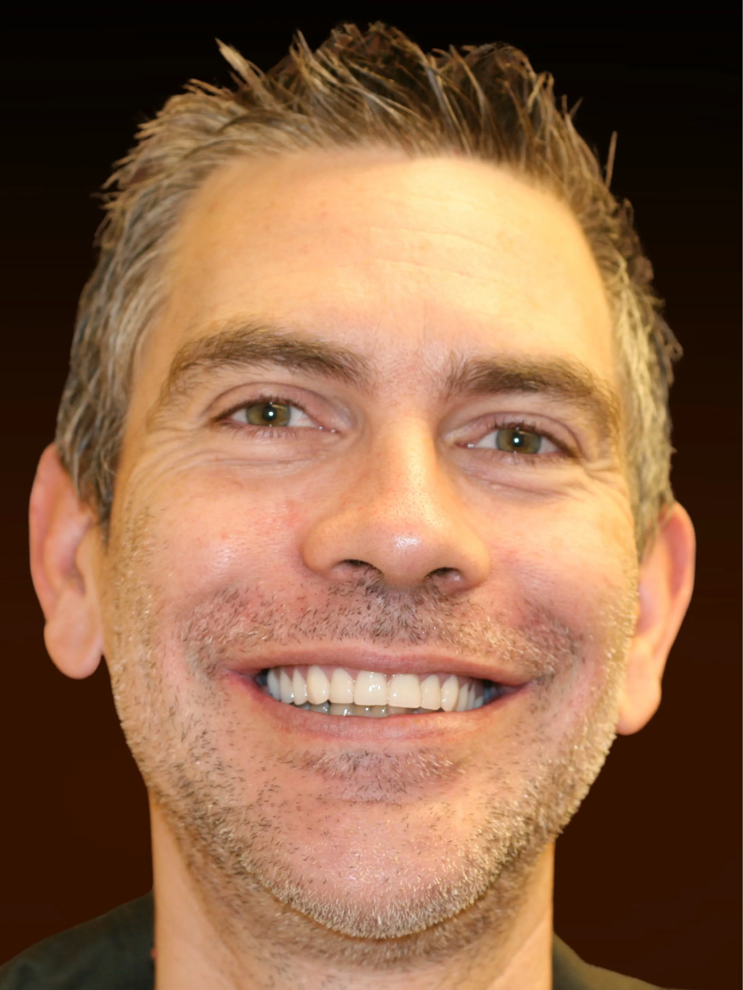 Patient Mike after All-on-X same-day dental implants at Implanted Wisdom, Highland IN