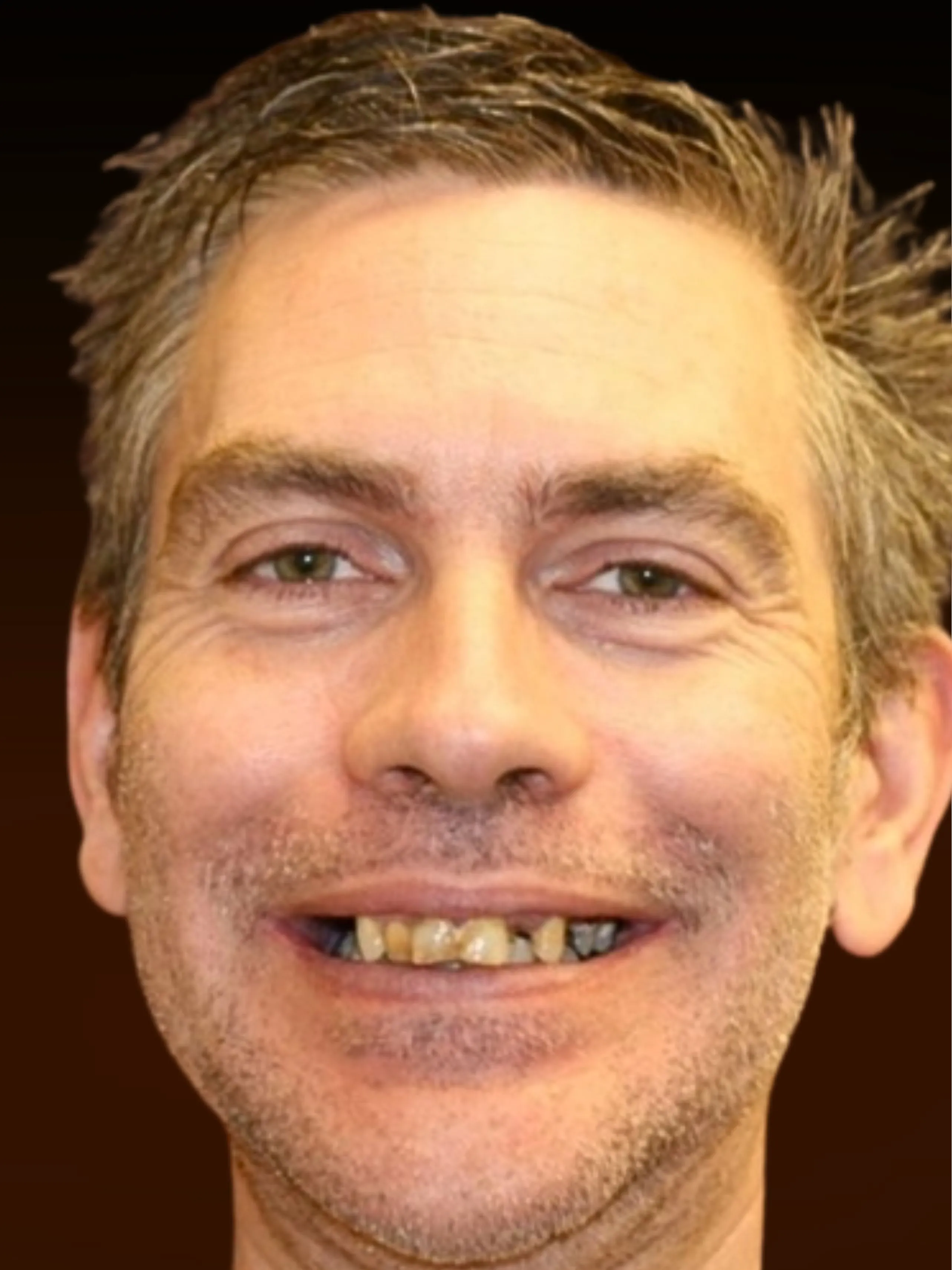 Patient Mike before full arch dental implants — failing teeth in Highland, Indiana