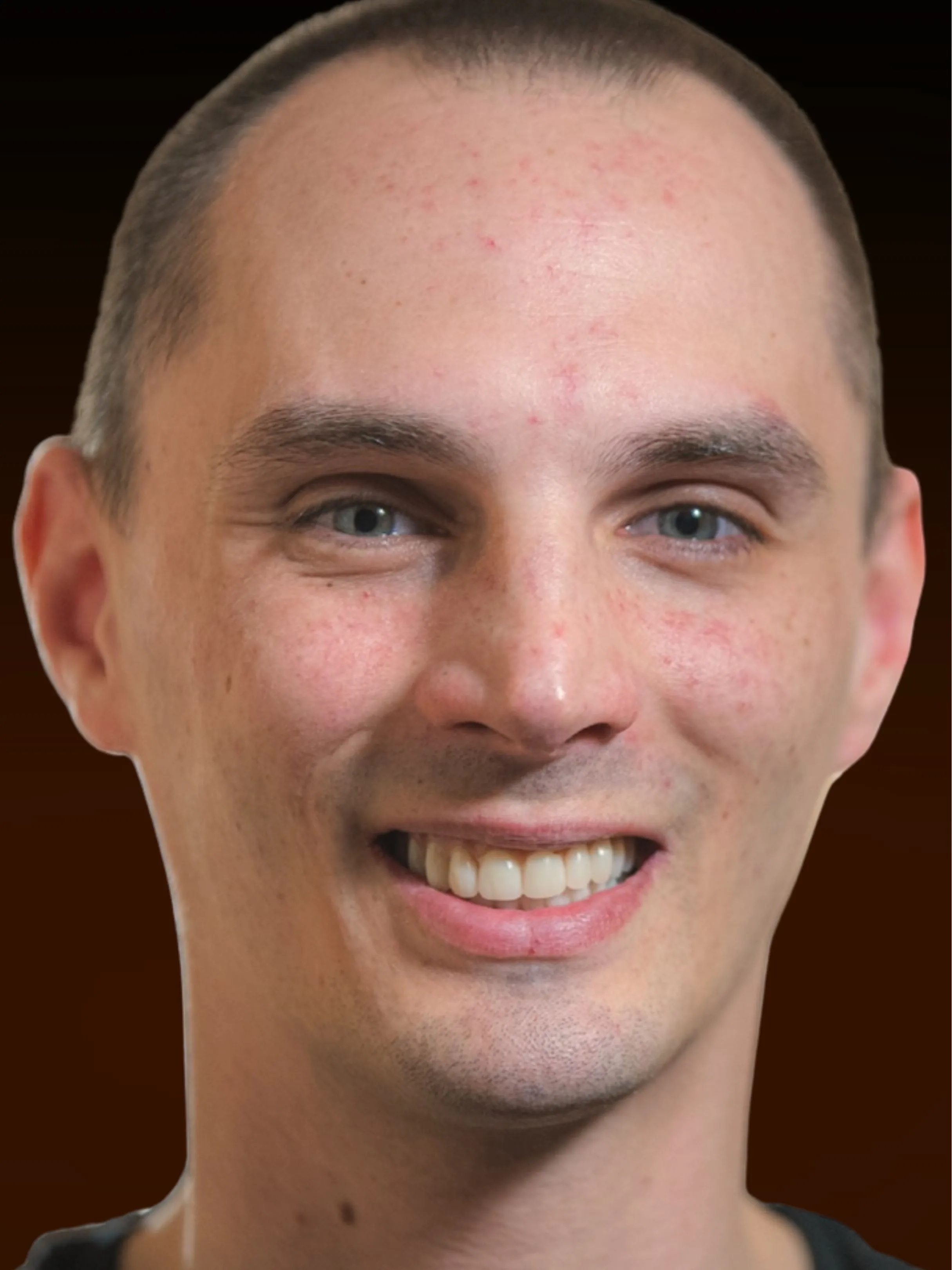 Patient Nick after full arch dental implants — teeth in a day at Implanted Wisdom, Highland IN