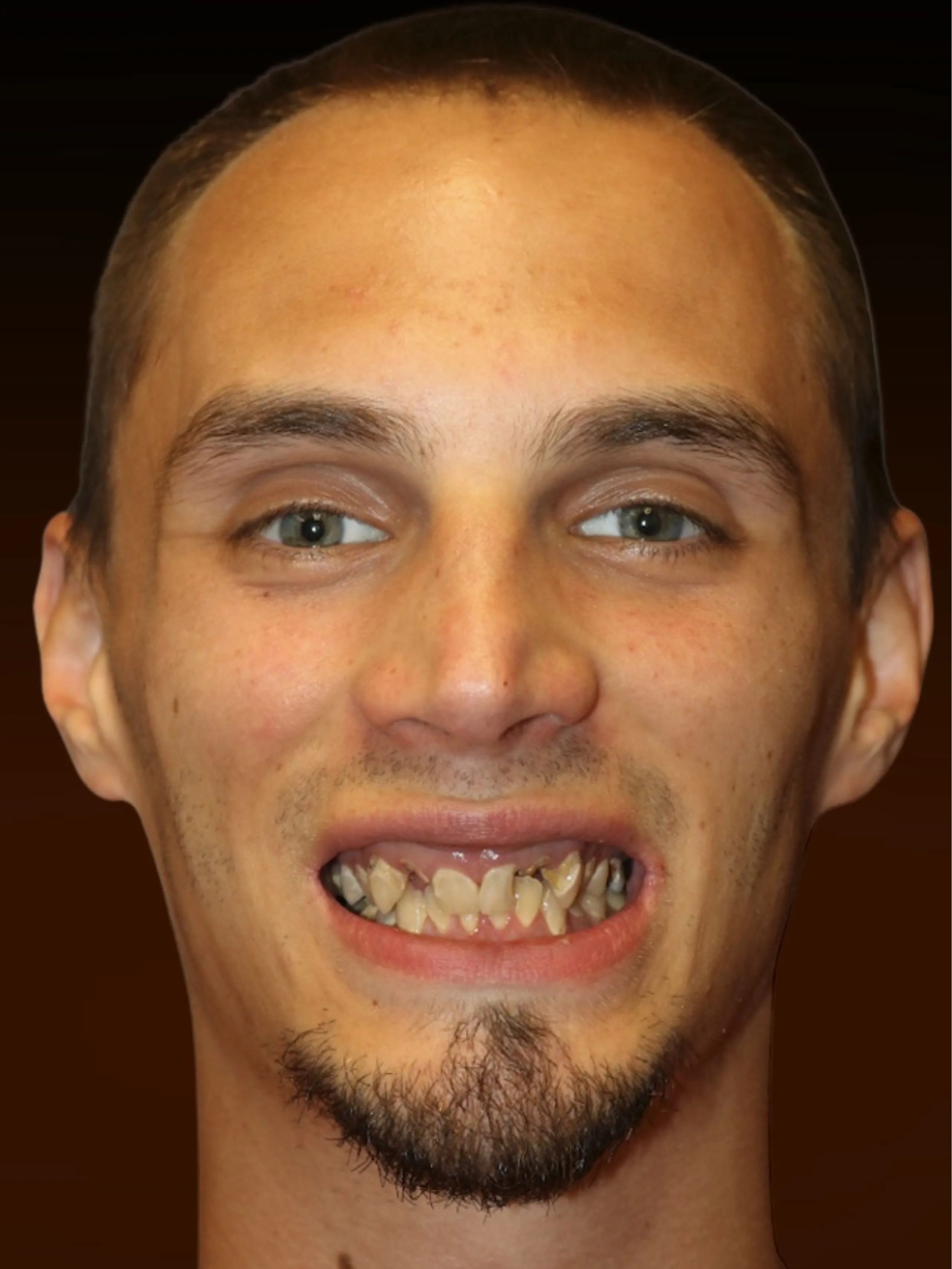 Patient Nick before full arch implant procedure at Pulver Oral Surgery, NW Indiana