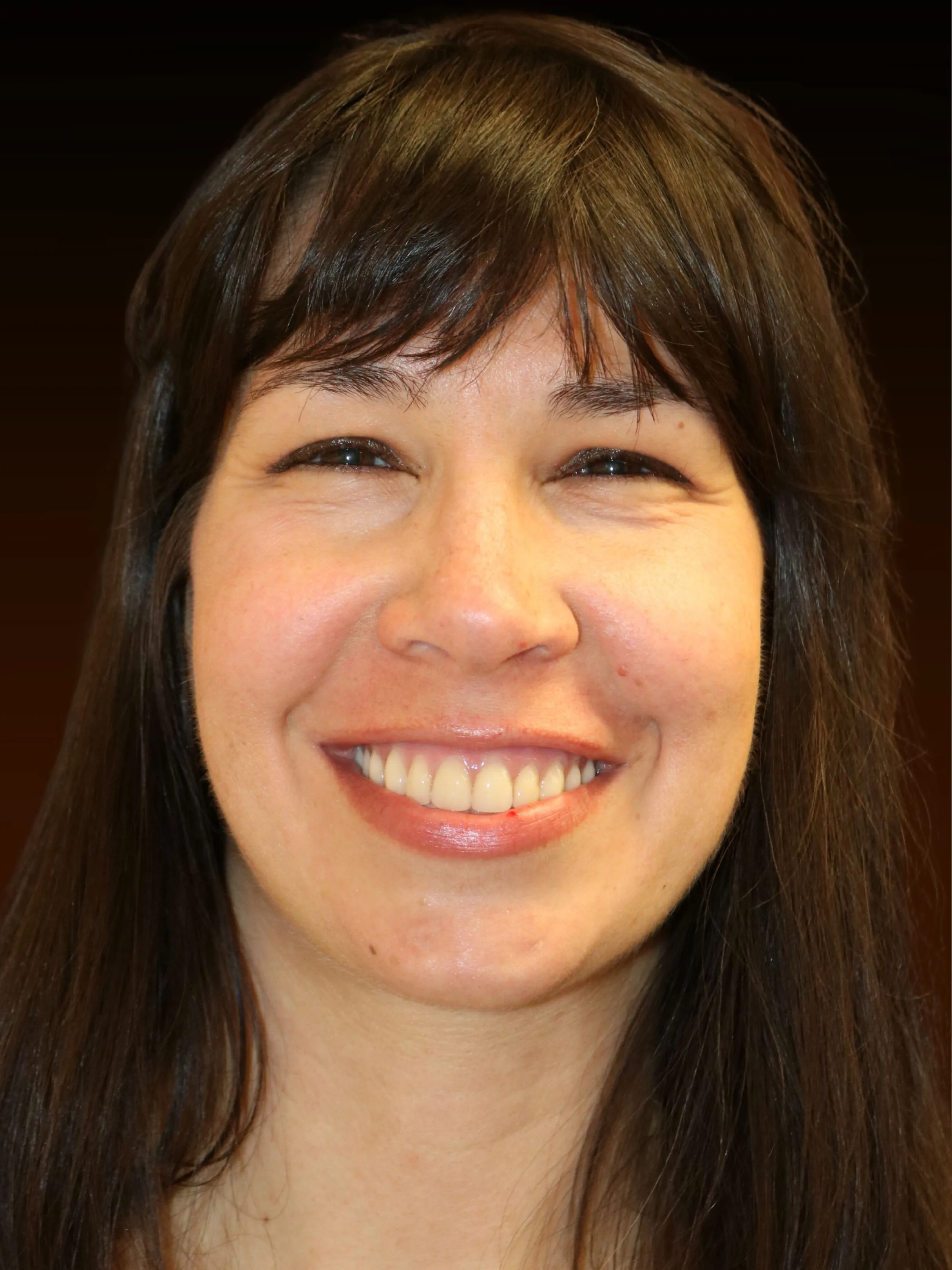 Patient Sarah after All-on-X full arch restoration at Implanted Wisdom, Highland Indiana