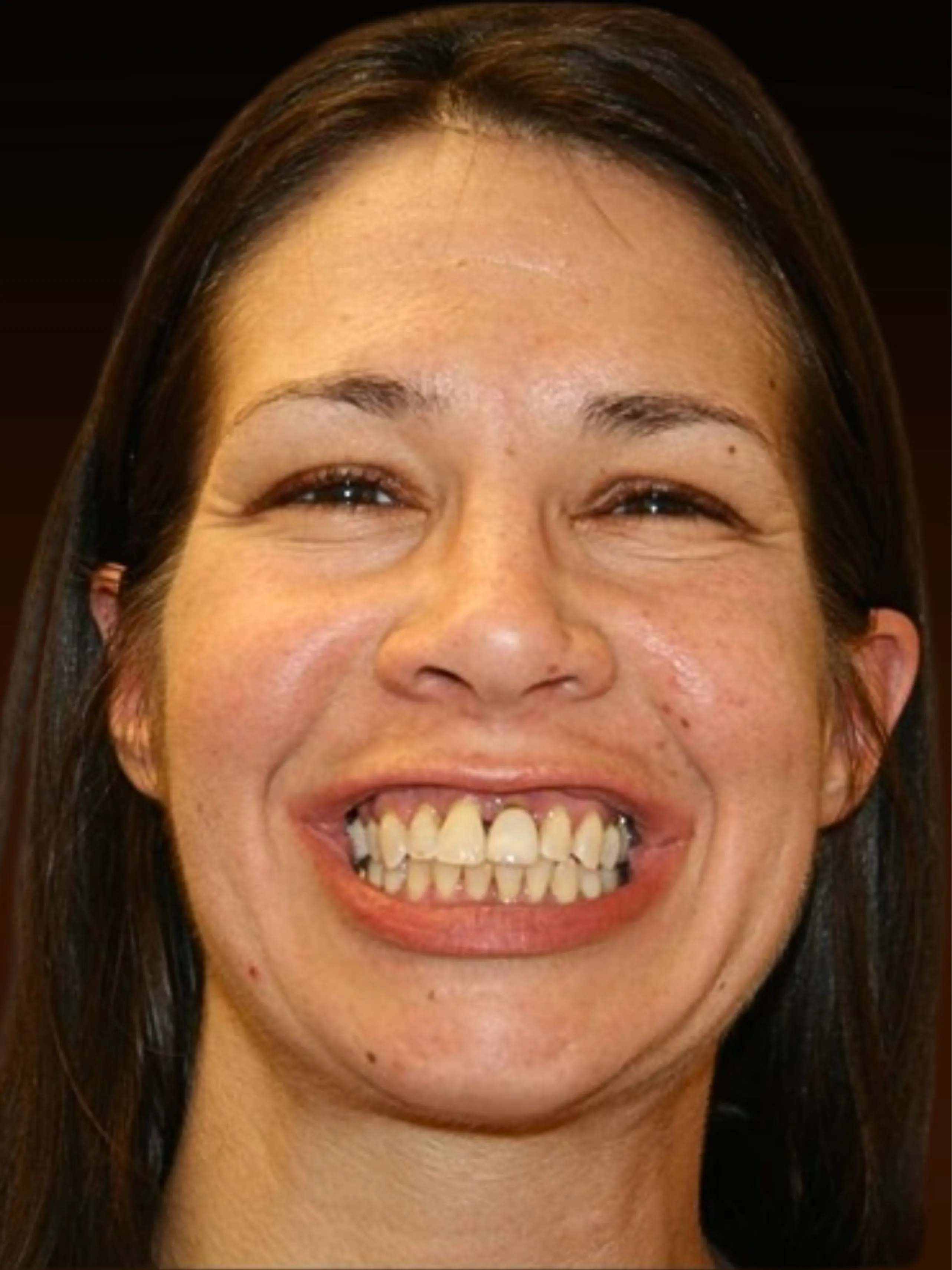 Patient Sarah before full arch dental implants at Implanted Wisdom, Highland IN