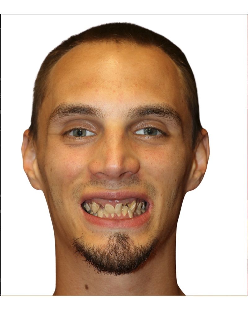 Nick before